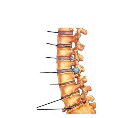 Osteokondrozun gelişim aşamaları